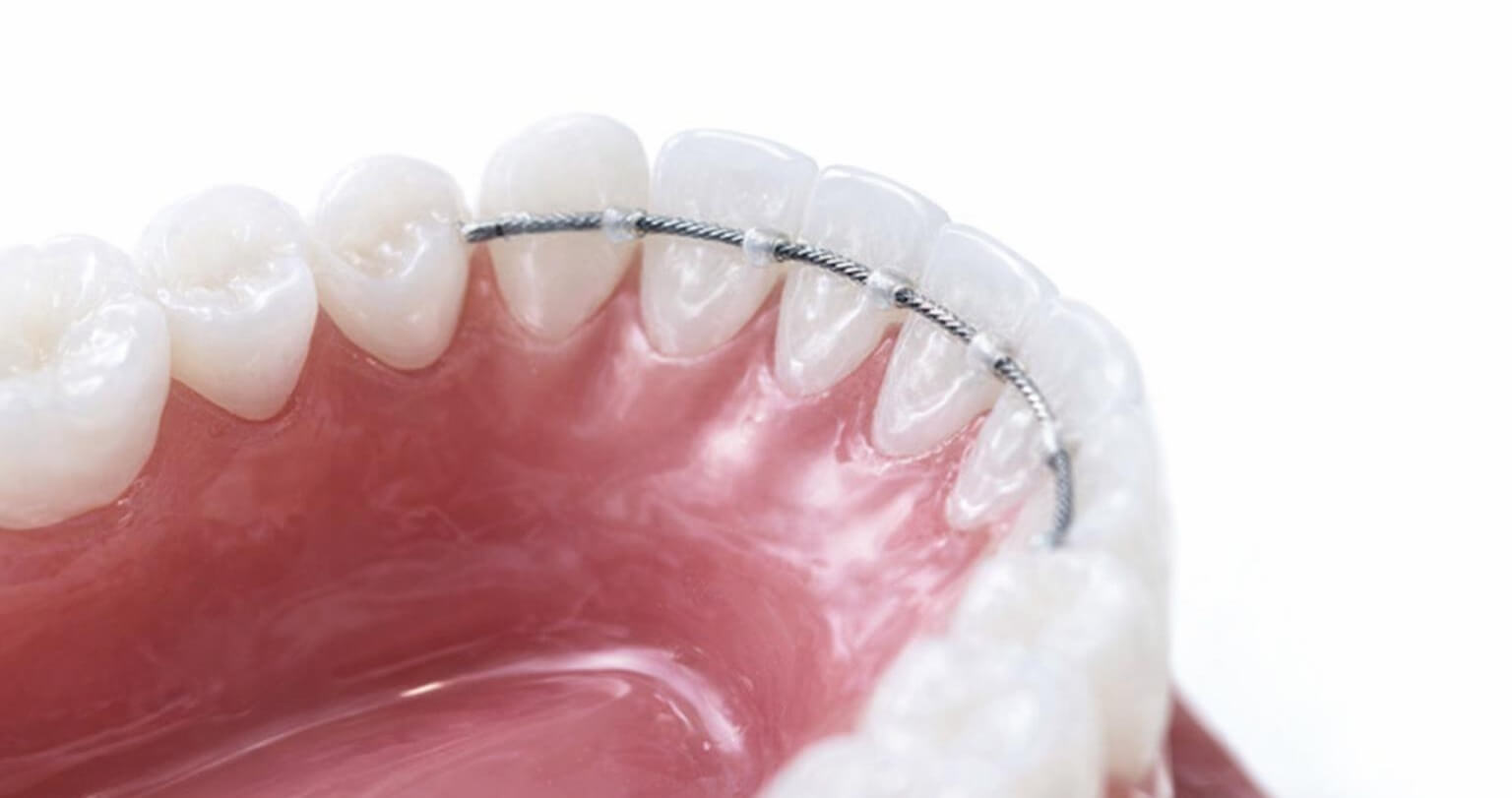 Festsitzender Retainer