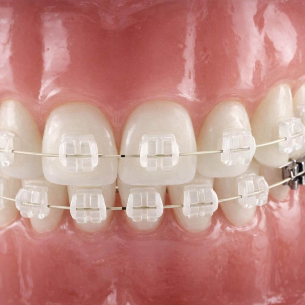 Keramikbrackets