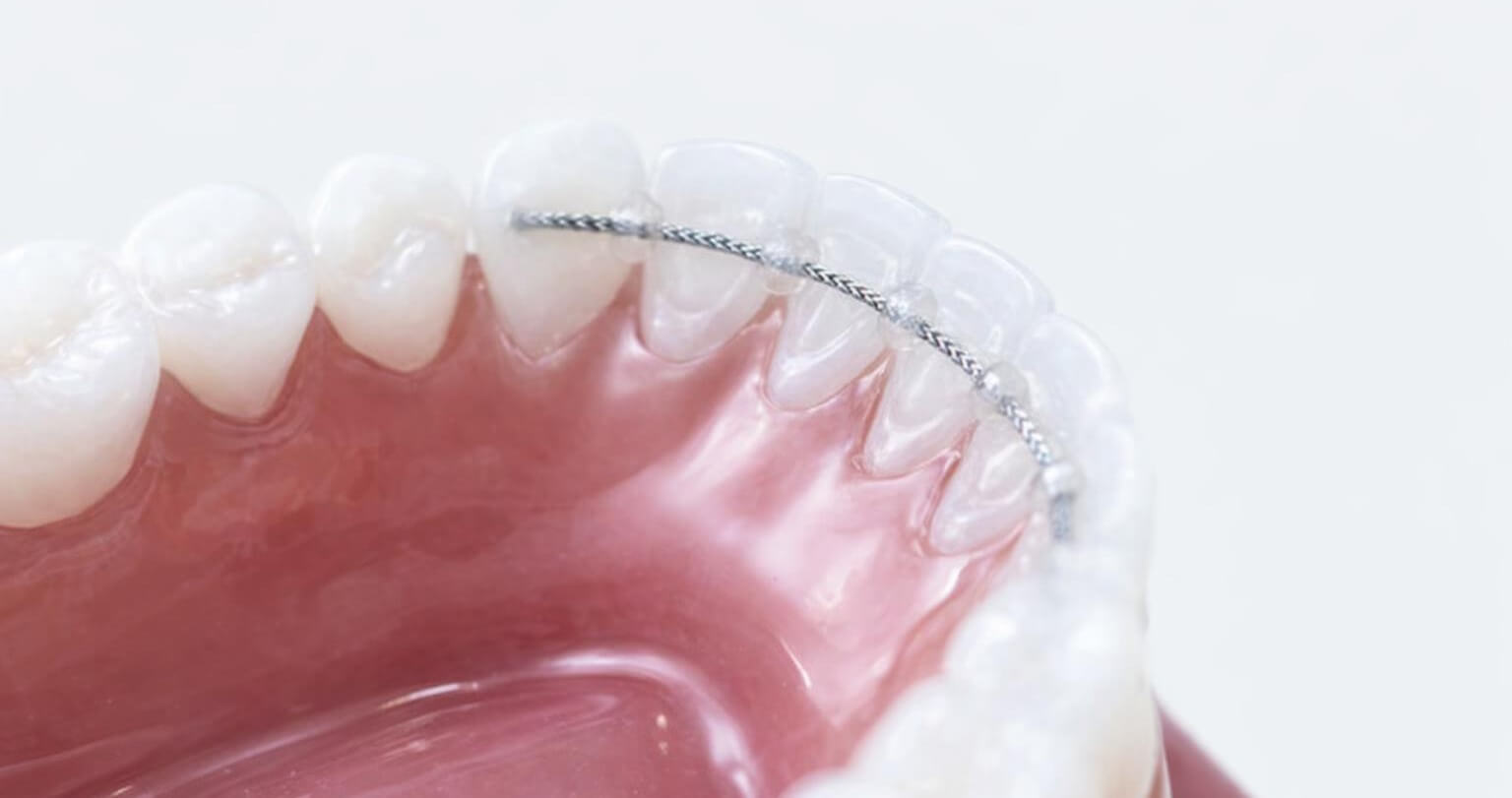 Retainer zur Stabilisierung des Behandlungsergebnisses