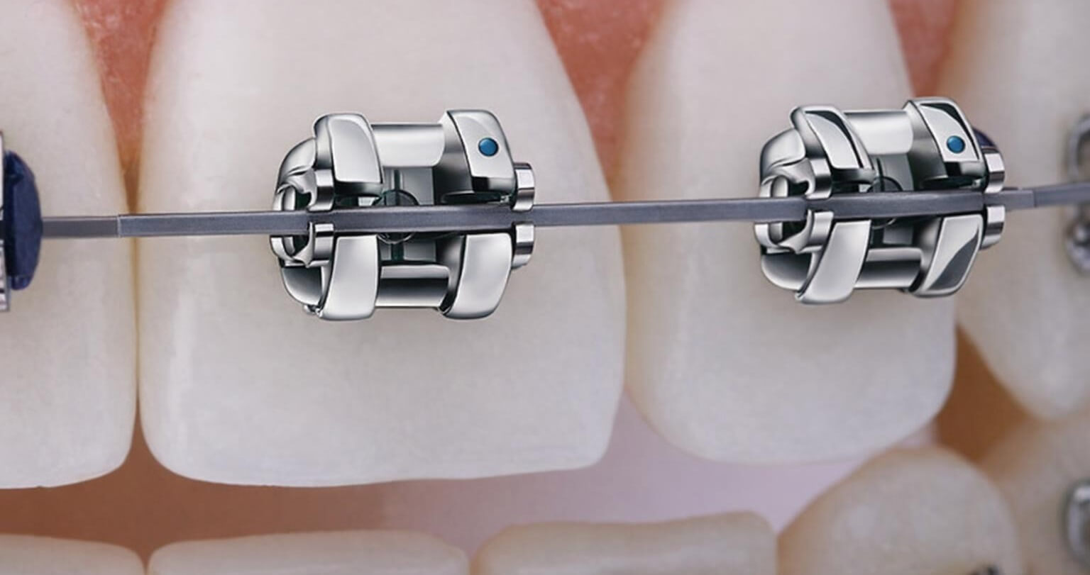 Selbstligierende Brackets